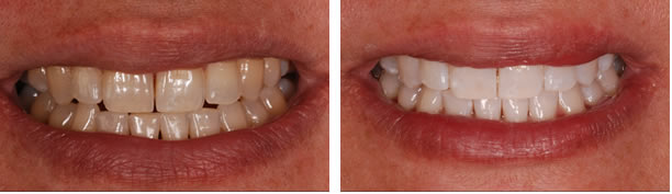 before_after
